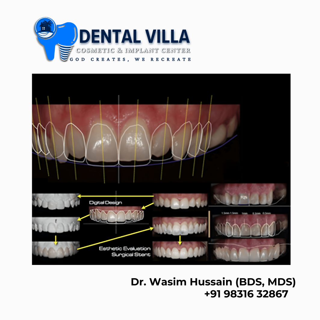 Smile Designing at dental villa howrah