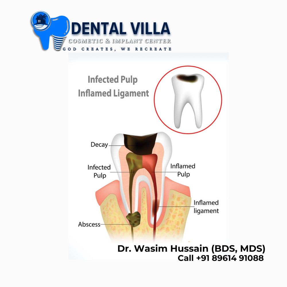 root canal treatment at Dental villa howrah