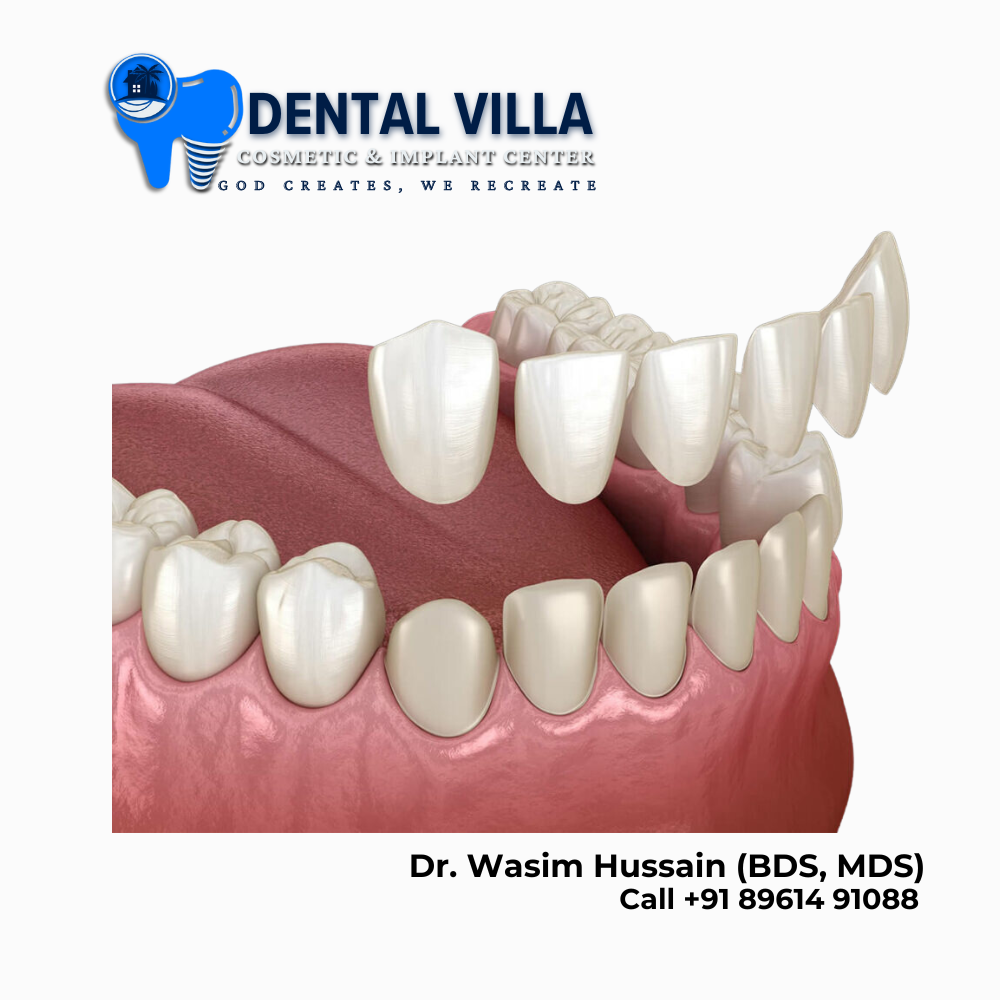 Veneers in khidirpur