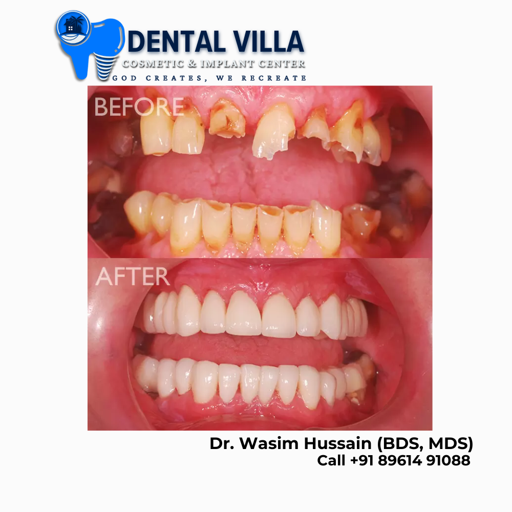 Full Mouth Rahabilitation in kolkata & howrah