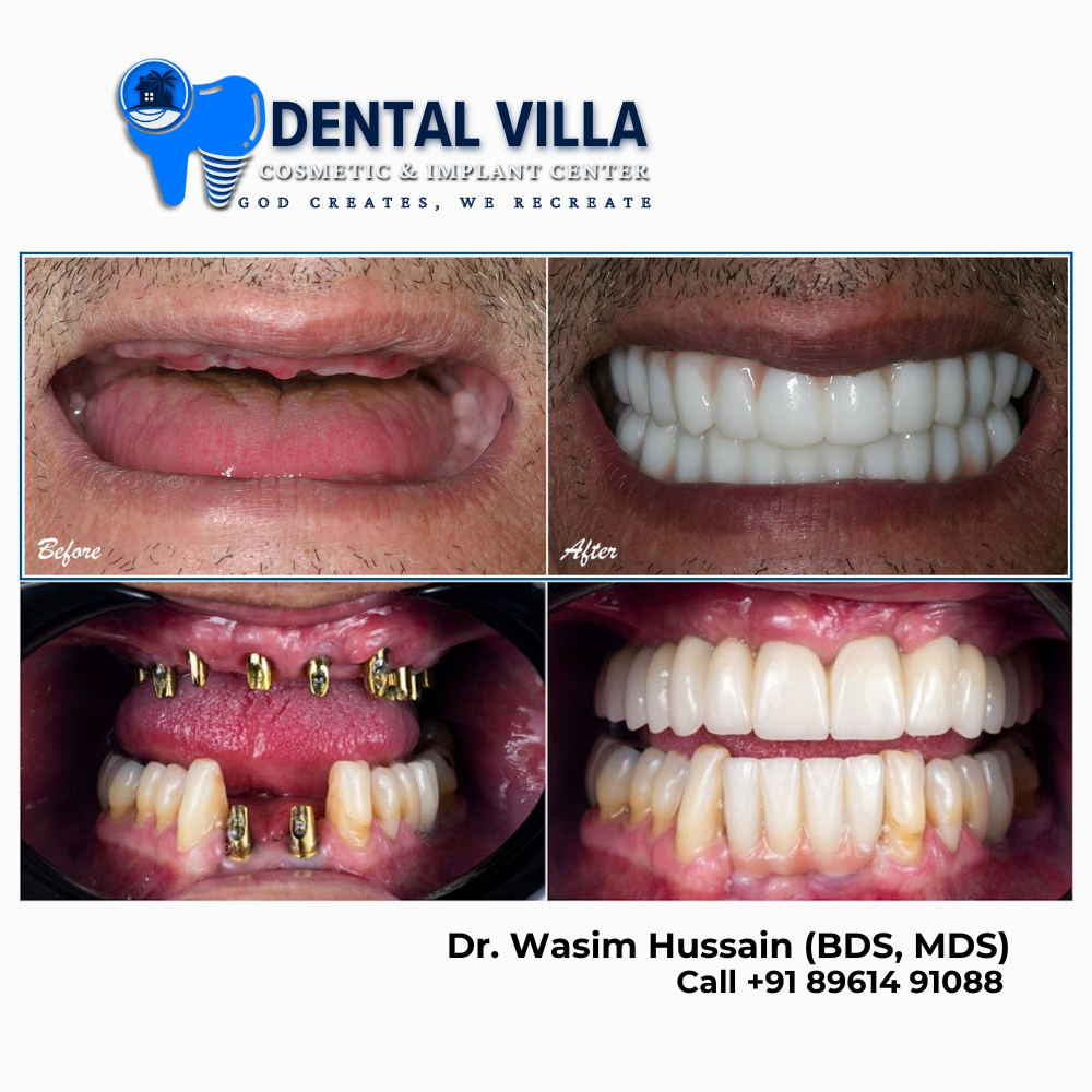 dental implant best khidirpur